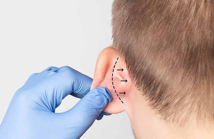 Ear Correction Surgery